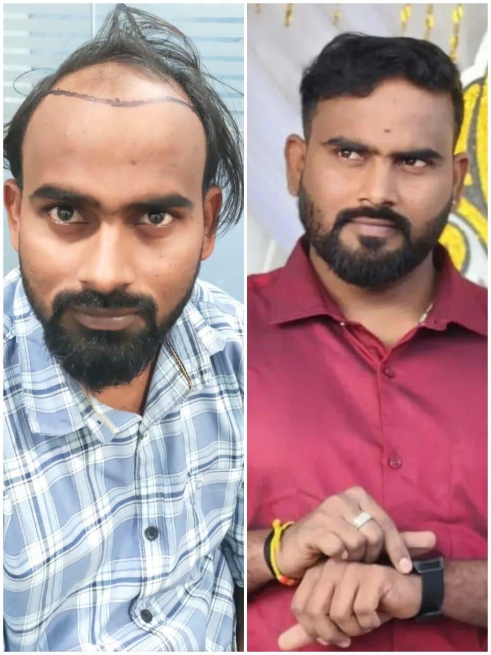Hair transplant result at Reborn Healthcare