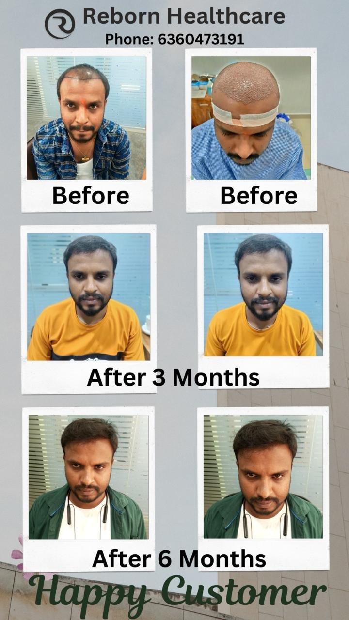 Hair transplant result at Reborn Healthcare