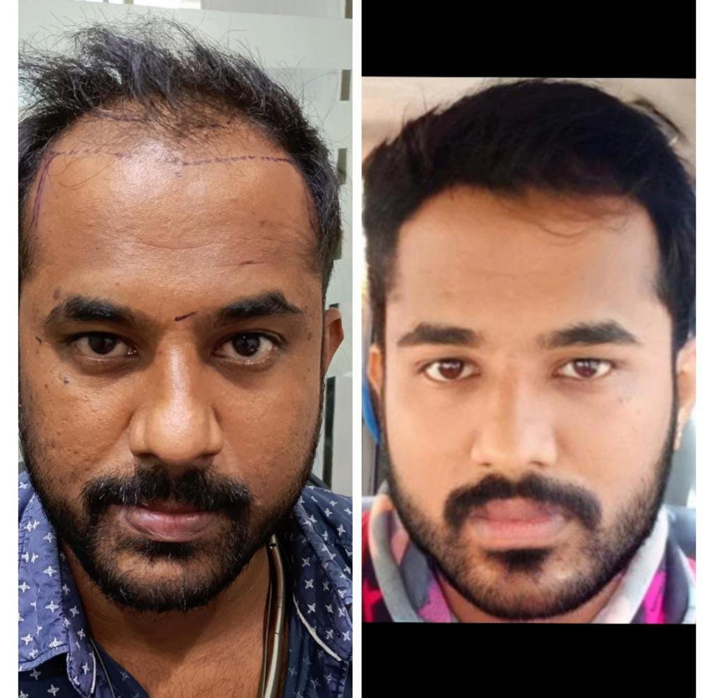 Hair transplant result at Reborn Healthcare