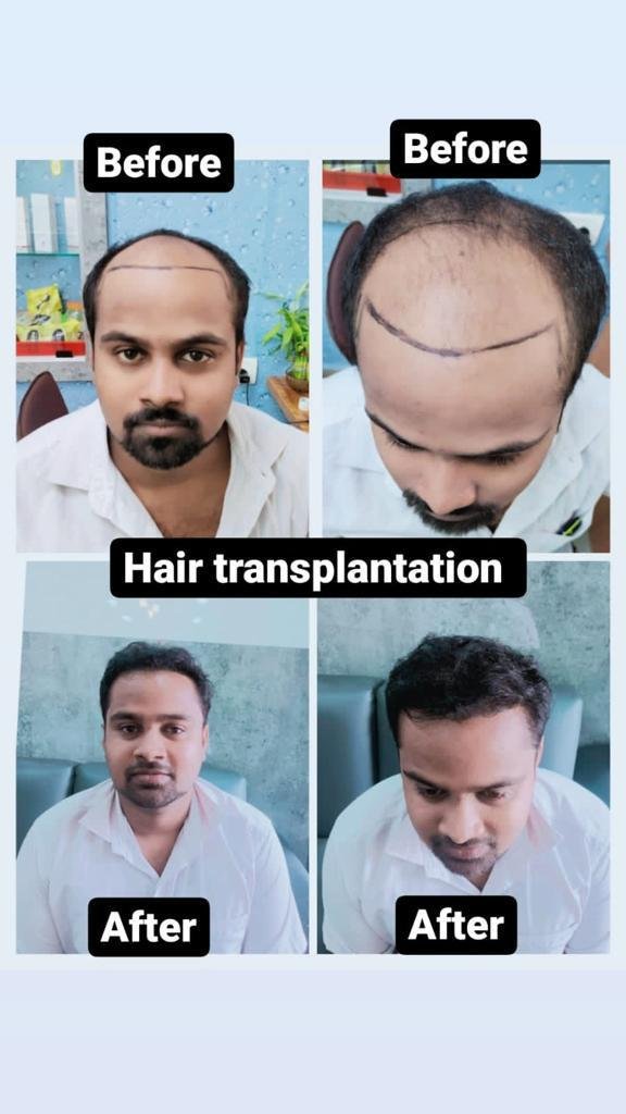 Hair transplant result at Reborn Healthcare