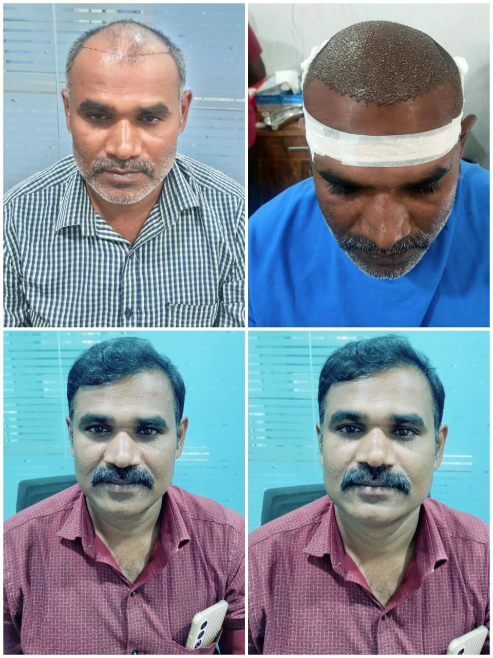Hair transplant result at Reborn Healthcare
